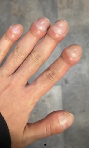 日本小哥手指肿得像乒乓球：结果被他解锁了先天洗头圣体！